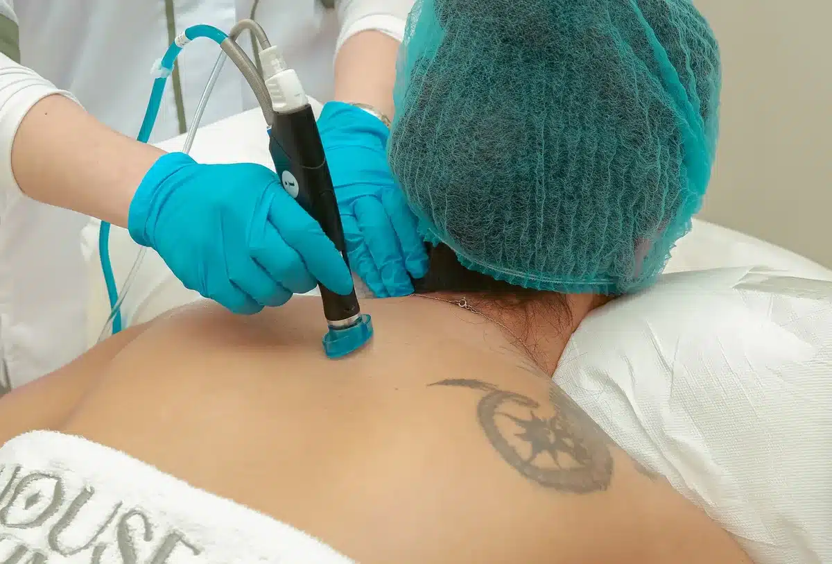 Seduta di rimozione con laser in ambiente clinico professionale